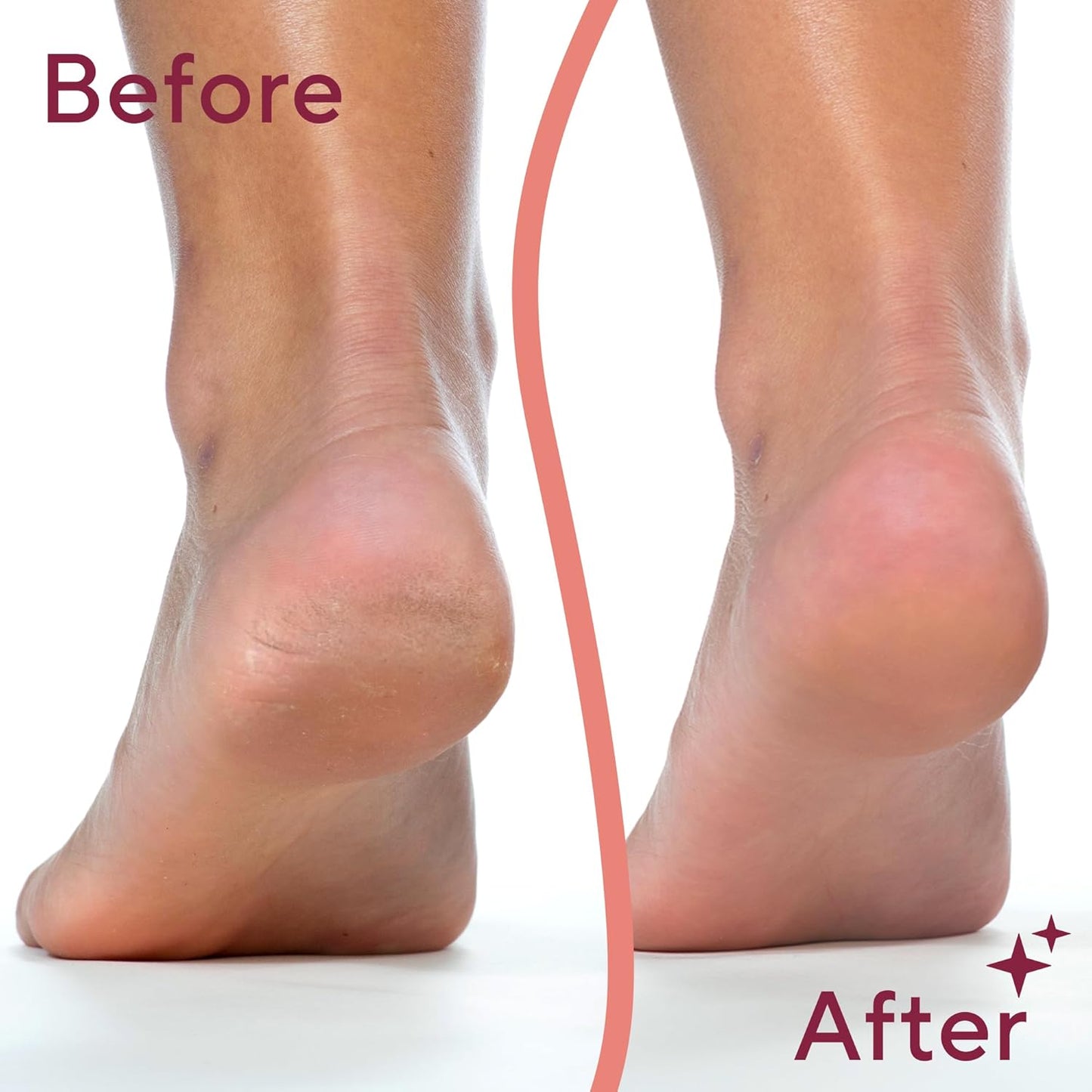 SoleGlide™ Callus Remover